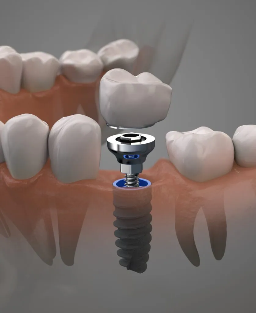 Implante humano de diente. Concepto On1. Innovación en prótesis dental. Ilustración 3D.