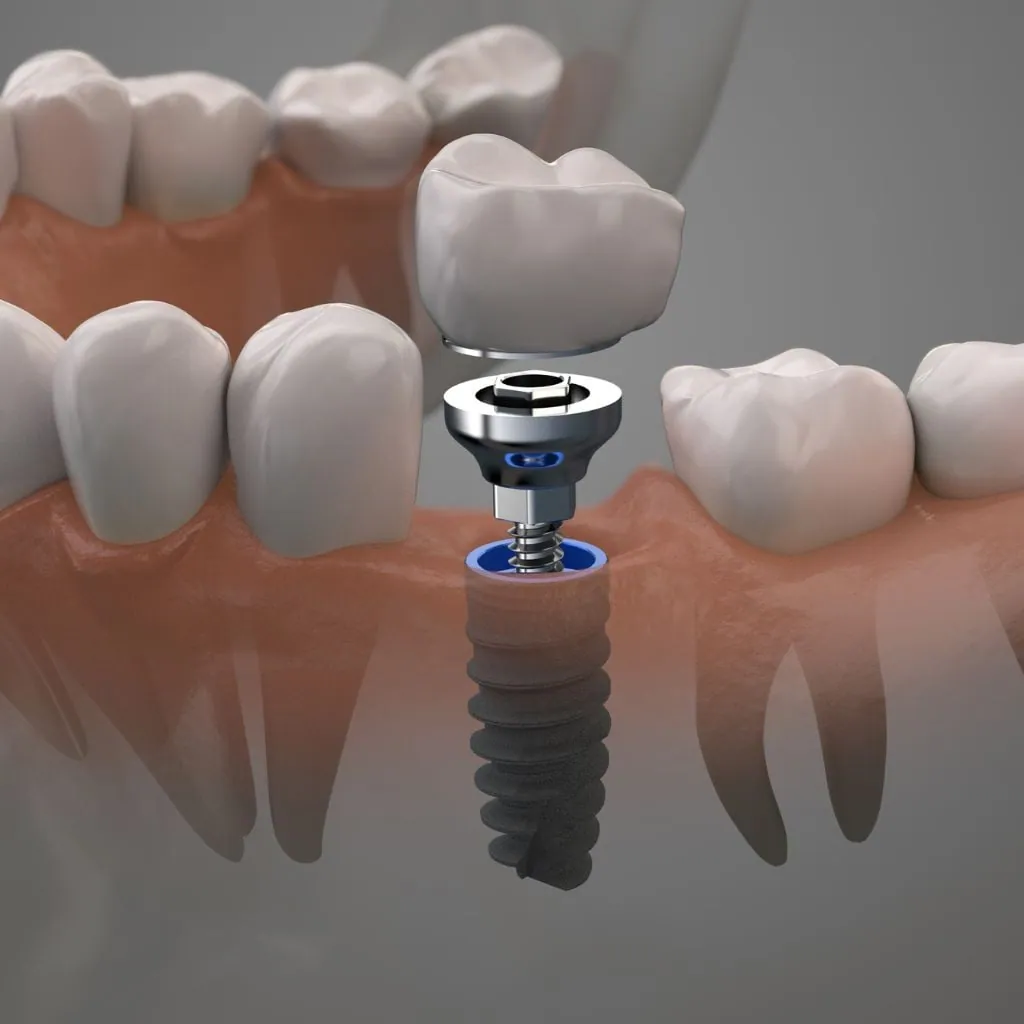 implantes dentales