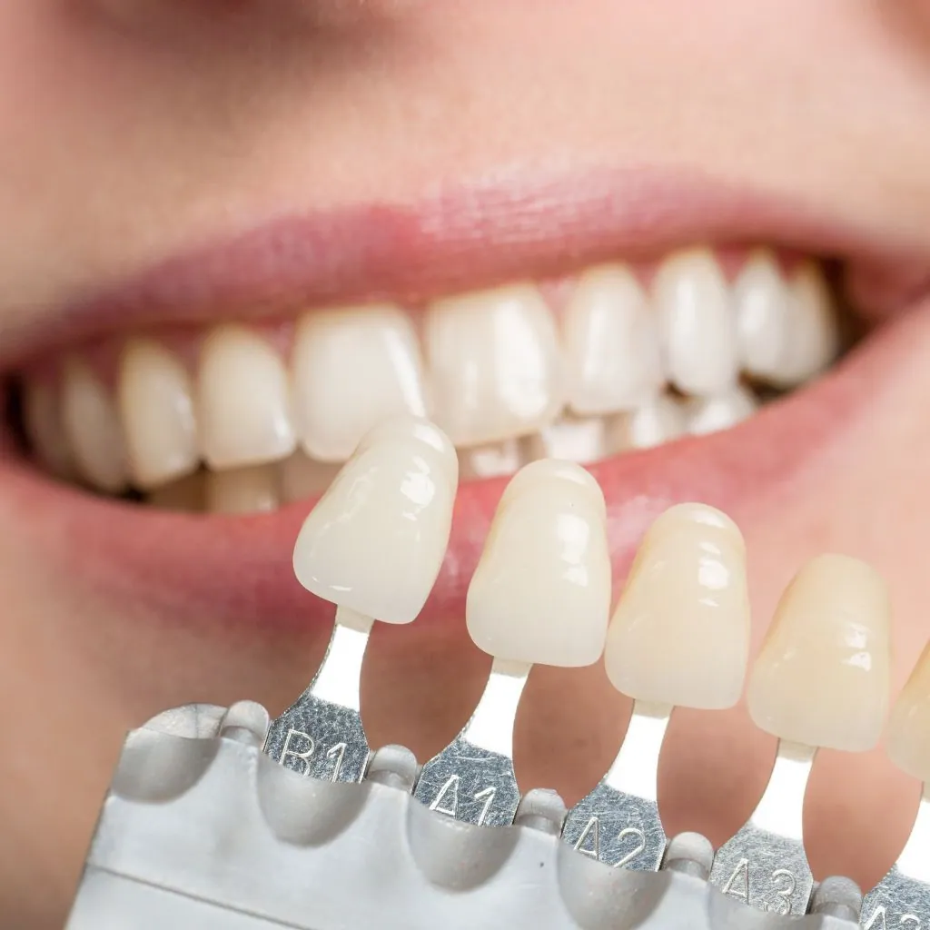 carillas dentales