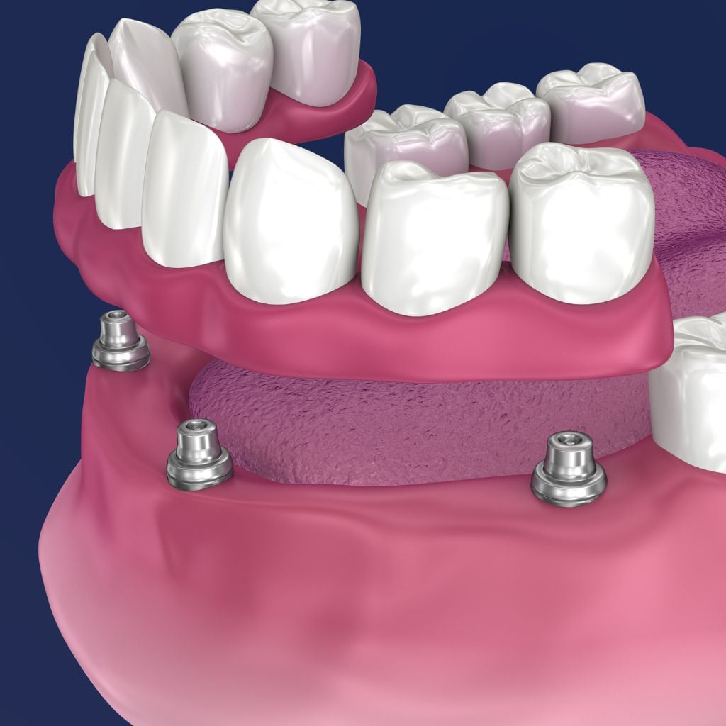 all on 4 dental implant