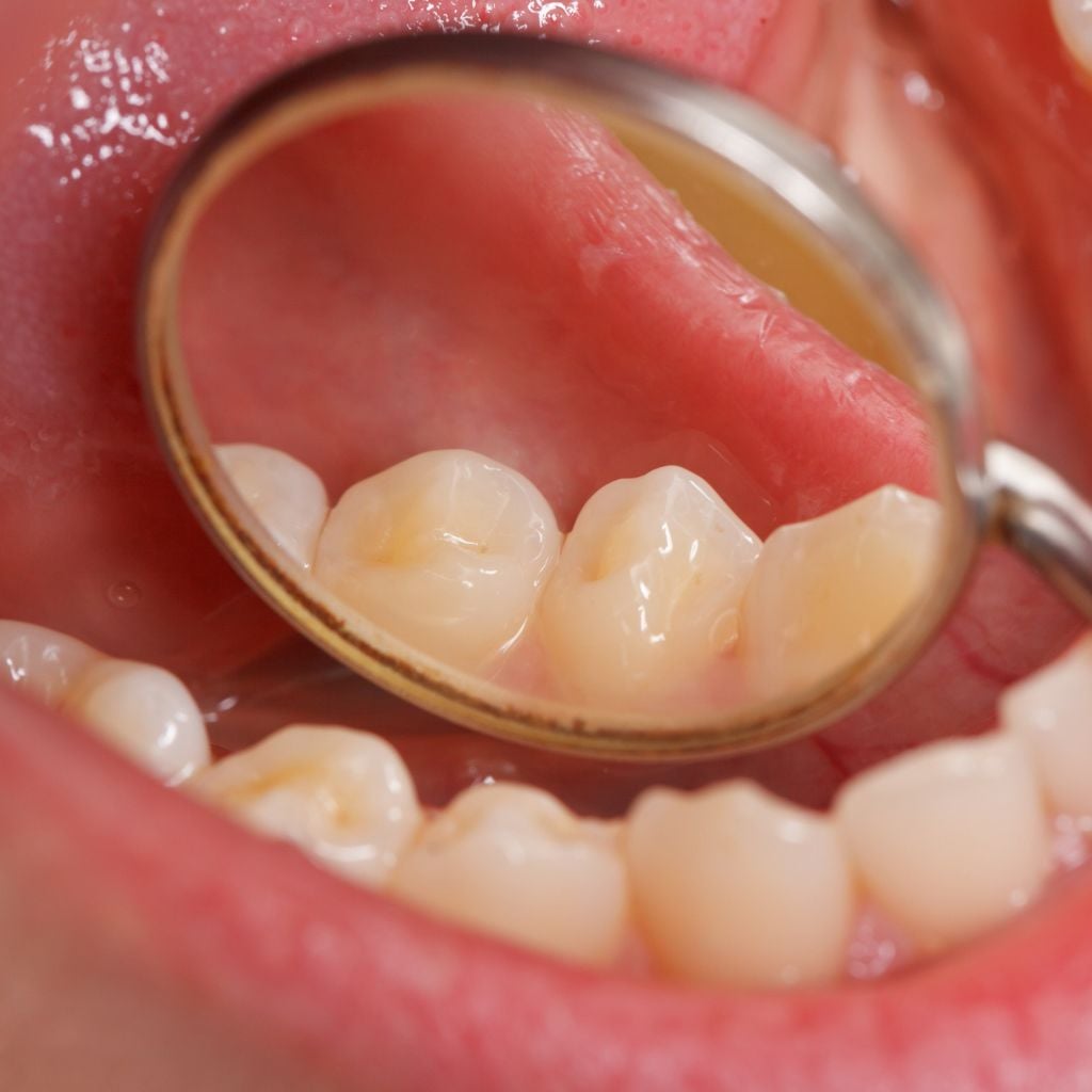 oral cancer screening