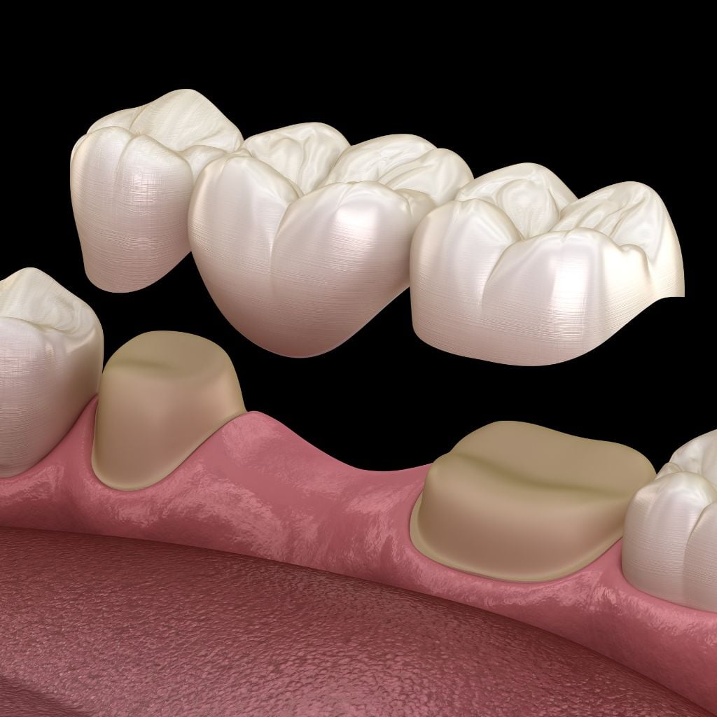 showing a dental bridge