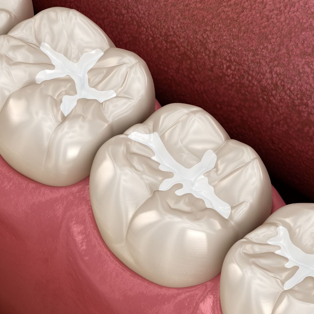 types of dental fillings