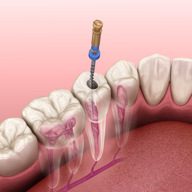 Endodontic root canal treatment process. Medically accurate toot