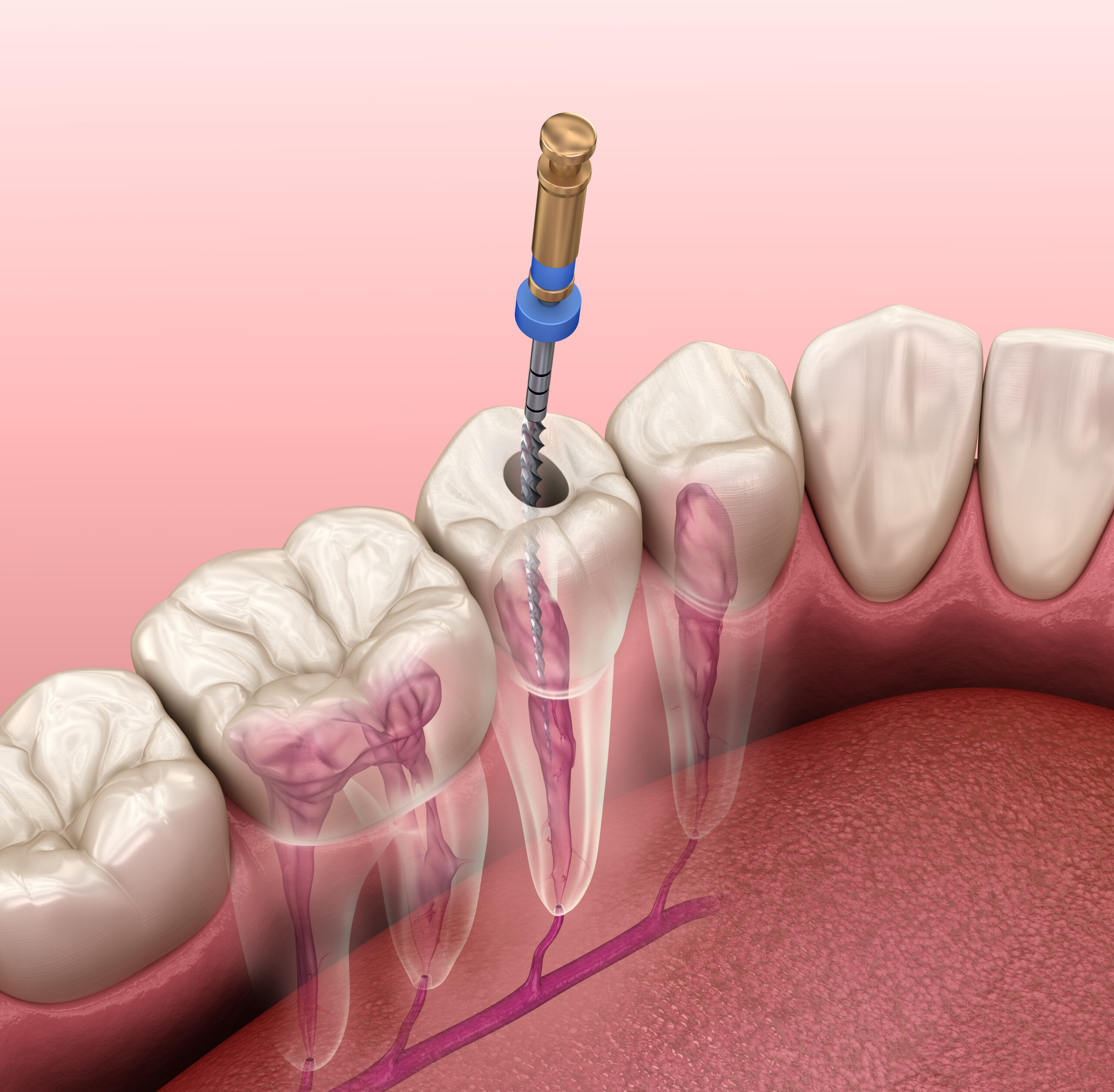 Endodontic root canal treatment process. Medically accurate toot