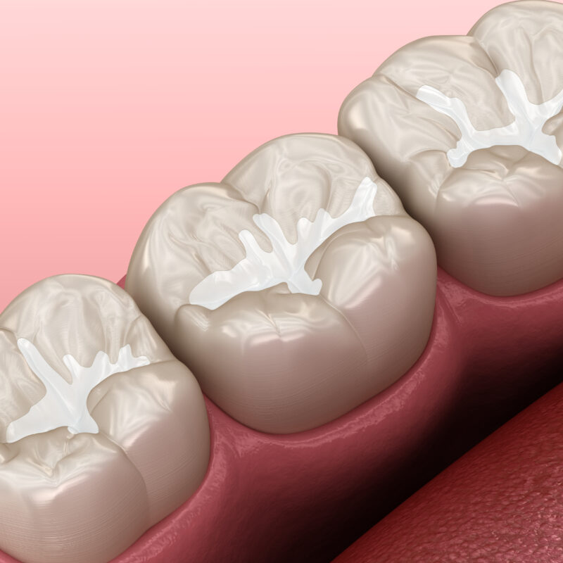 Molar Fissure dental fillings, Medically accurate 3D illustration of dental concept