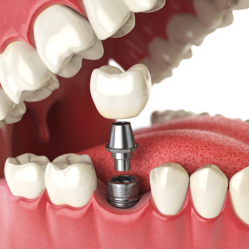 Tooth human implant. Dental concept. Human teeth or dentures. 3d illustration