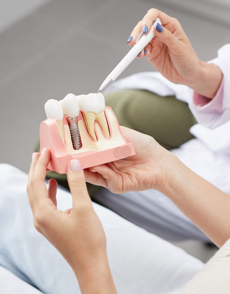 Explaining Tooth Implantation