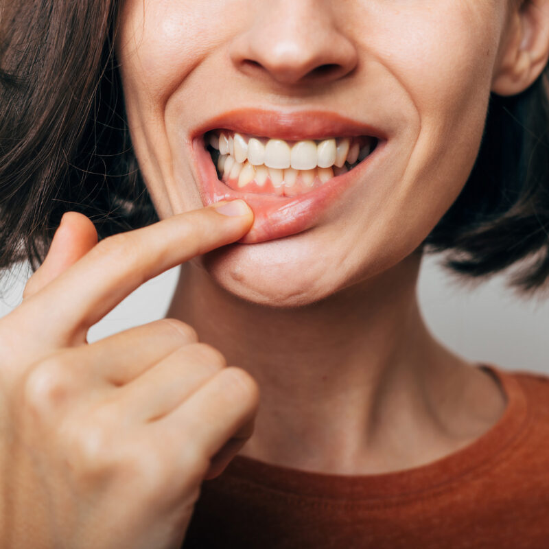 Close up shot of gum inflammation. Cropped shot of a young woman showing red bleeding gums isolated on a gray background. Dentistry, dental care