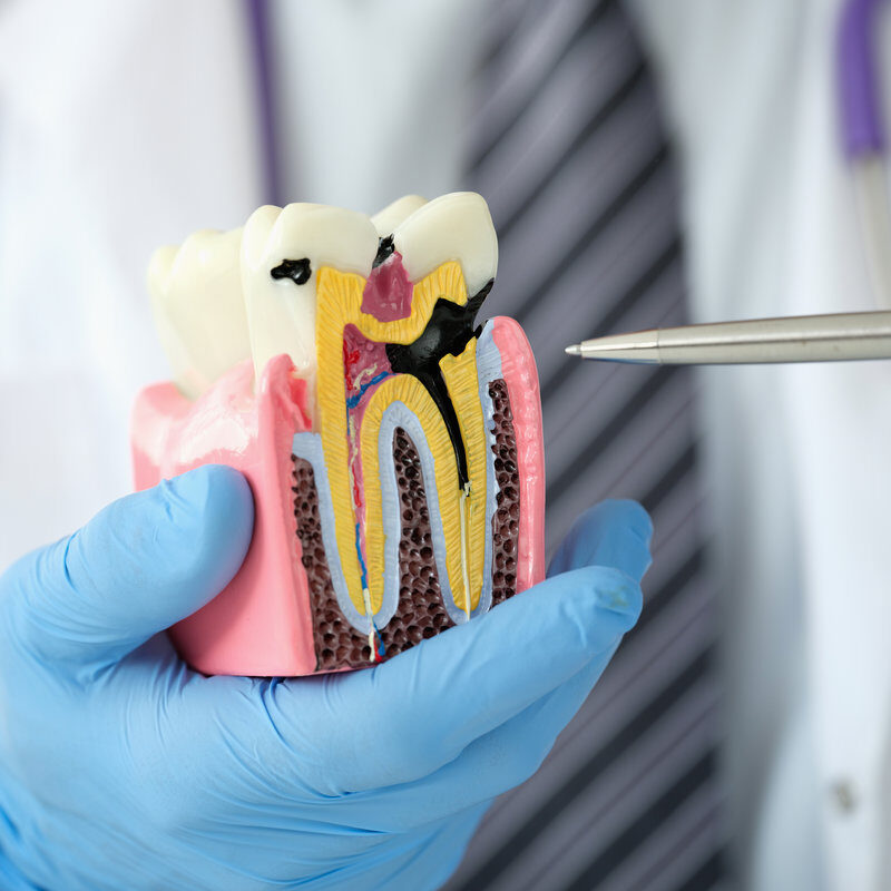 Doctor dentist showing pen on carious cavity on artificial plastic model of tooth closeup. Medical dental education concept