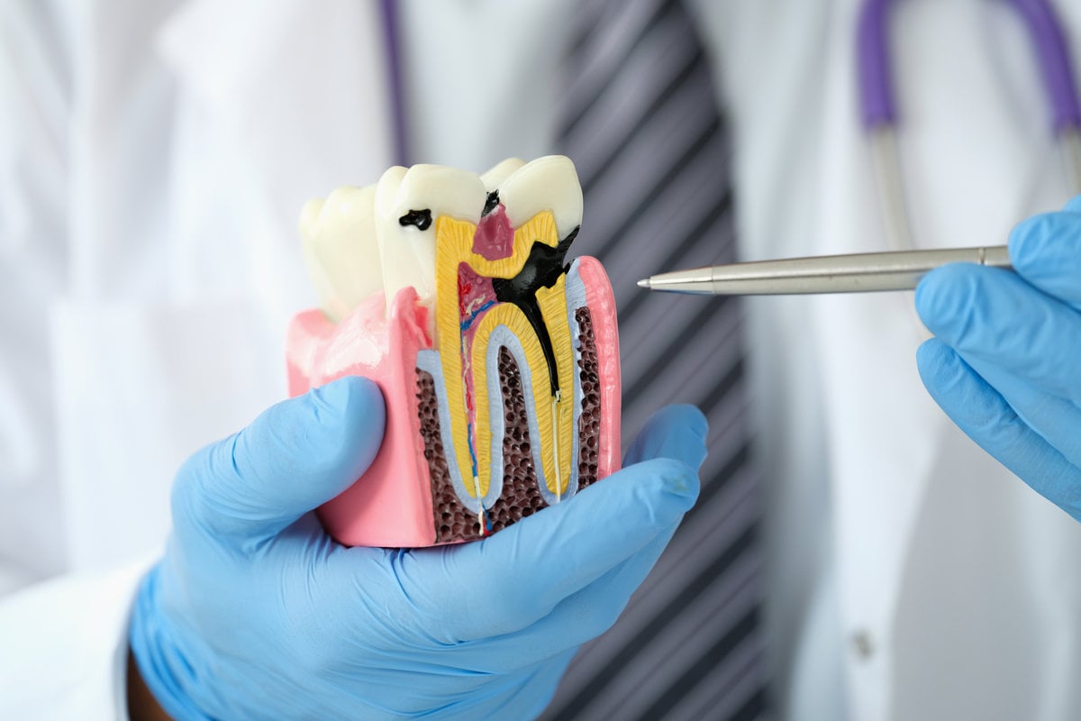 Doctor dentist showing pen on carious cavity on artificial plastic model of tooth closeup. Medical dental education concept